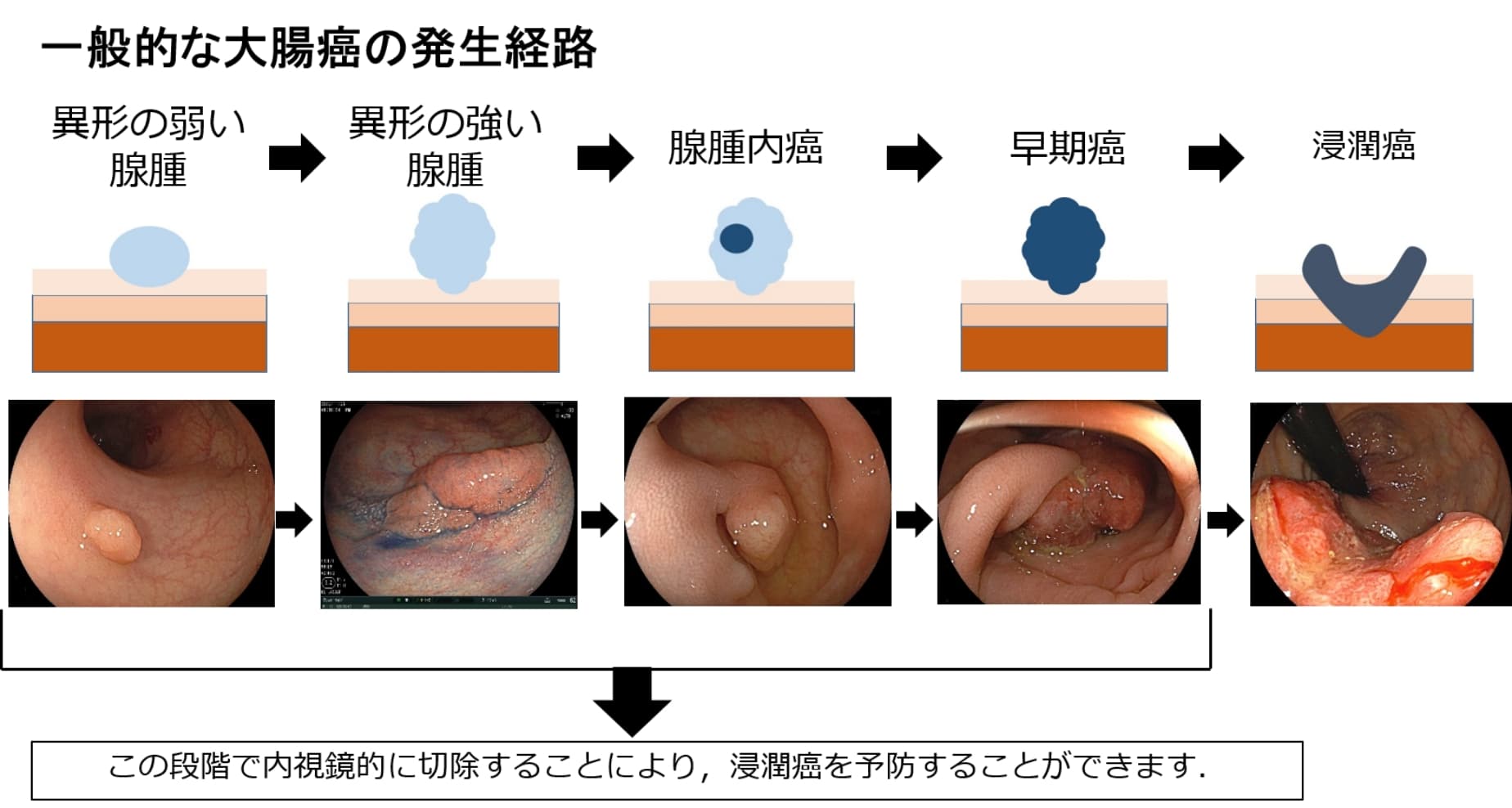 一般的な大腸癌の発生経路の画像